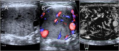 Assessment of Carotid Body Tumors by Superb Microvascular Imaging of Feeding Arteries During Preoperative Evaluation